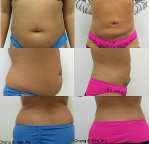 CARDISPAN BEFORE AFTER PICS
